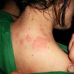 Itchy Skin